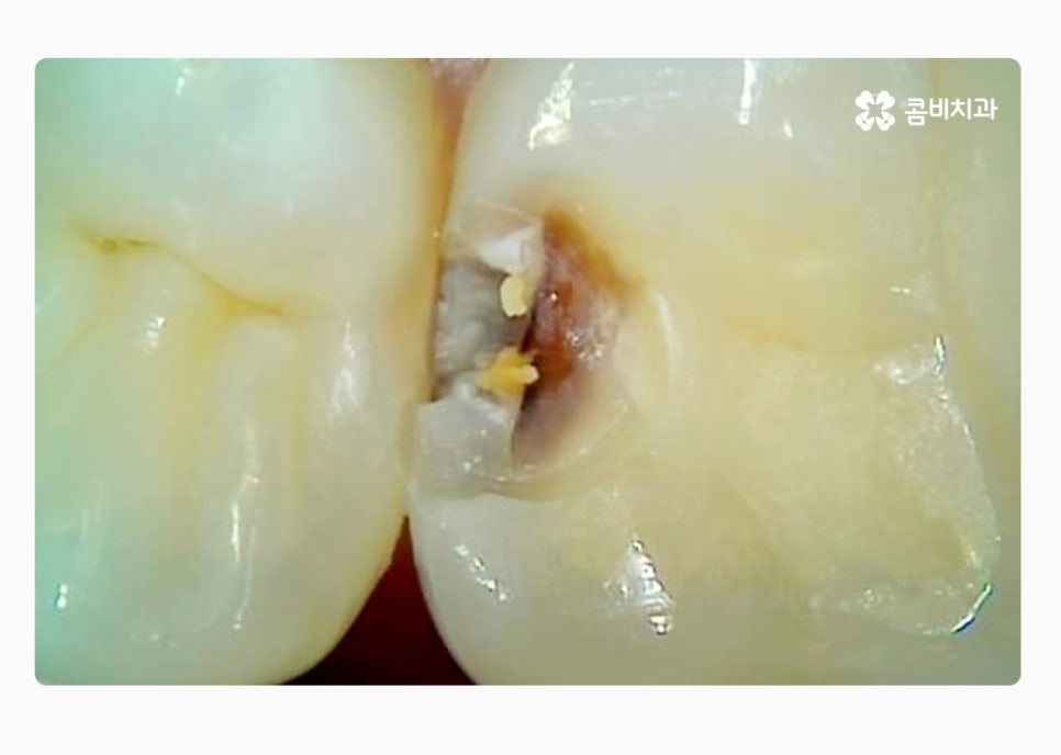 치아 사이 충치 육안으로는 알기 어려워요 관련 이미지 3