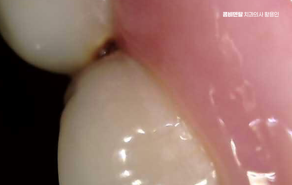 신경치료 아픈가요 망설이시는 분들이라면 관련 이미지 8