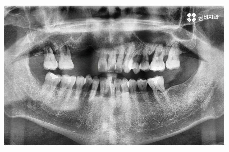 임플란트 수술 신중하게 결정하려면 관련 이미지 1