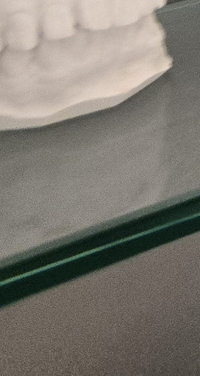 사랑니 주변 잇몸 통증 지금부터가 중요하니까 관련 이미지 44