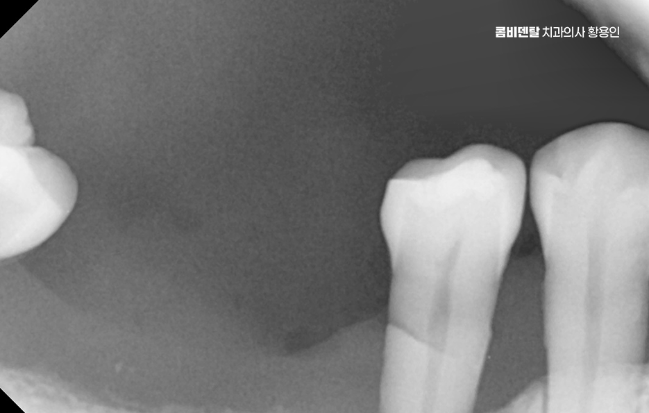 어금니 발치후 임플란트 안하면 어떻게 변하는걸까 관련 이미지 4