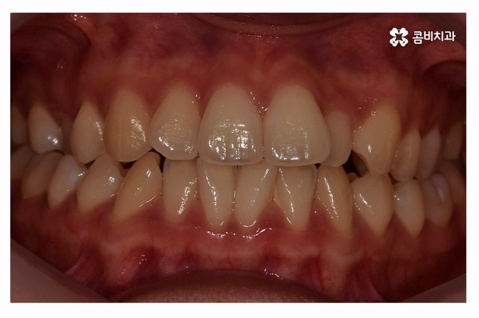 덧니교정 체계적으로 준비하려면 관련 이미지 1