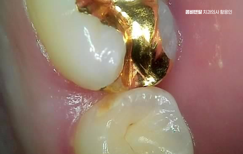 어금니 뒤 잇몸 부음 어떤 문제길래 이런거죠 관련 이미지 1