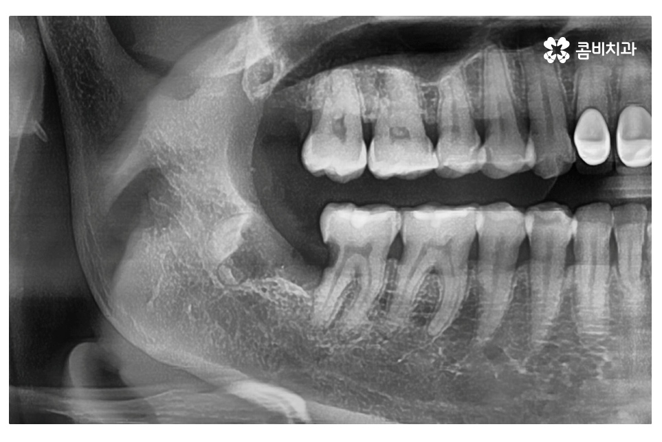 누운 사랑니 발치와 어금니신경치료를 하게 된 사례 관련 이미지 4
