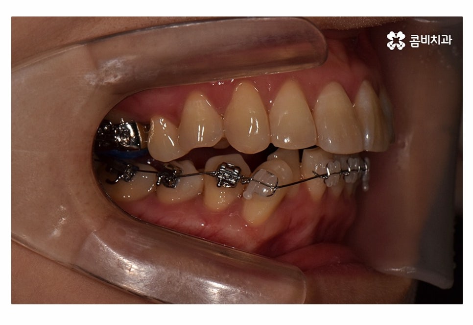 치아설측교정 가능한지 궁금하다면 관련 이미지 6