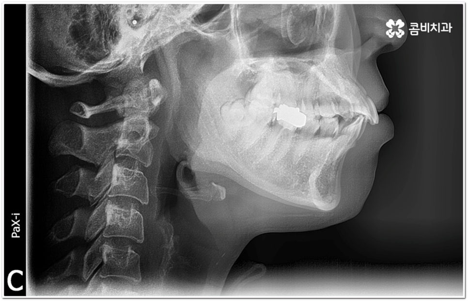 돌출입교정치과 알아보는 기준은 관련 이미지 1