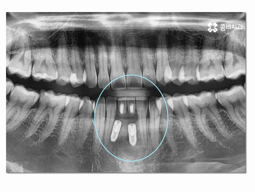 치주염으로 인한 아랫니 임플란트 절차를 알아보면 관련 이미지 8