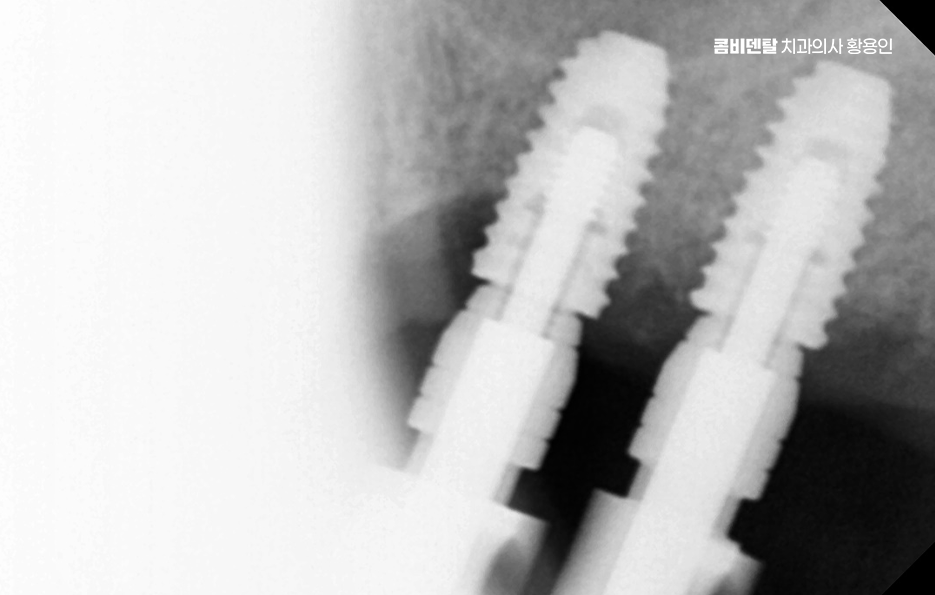 어르신 임플란트 지원 현명하게 활용하려면 관련 이미지 8