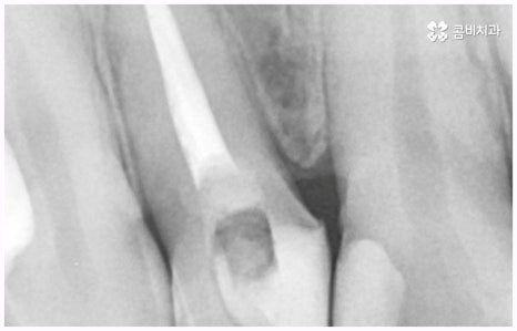 임플란트 종류 어떤게 맞을까요? 관련 이미지 5