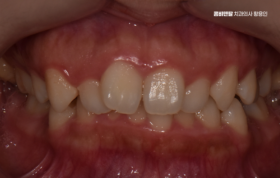 비발치 돌출입 교정 어떨때 적절할까 관련 이미지 2