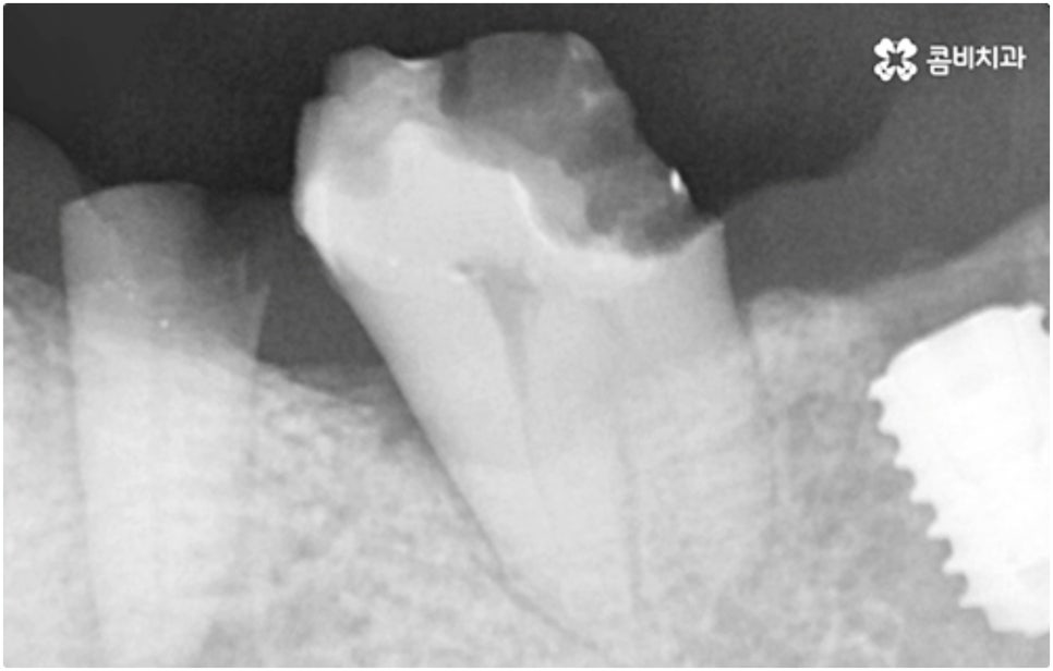 어금니임플란트 살펴볼 사항들은 무엇인가요? 관련 이미지 11