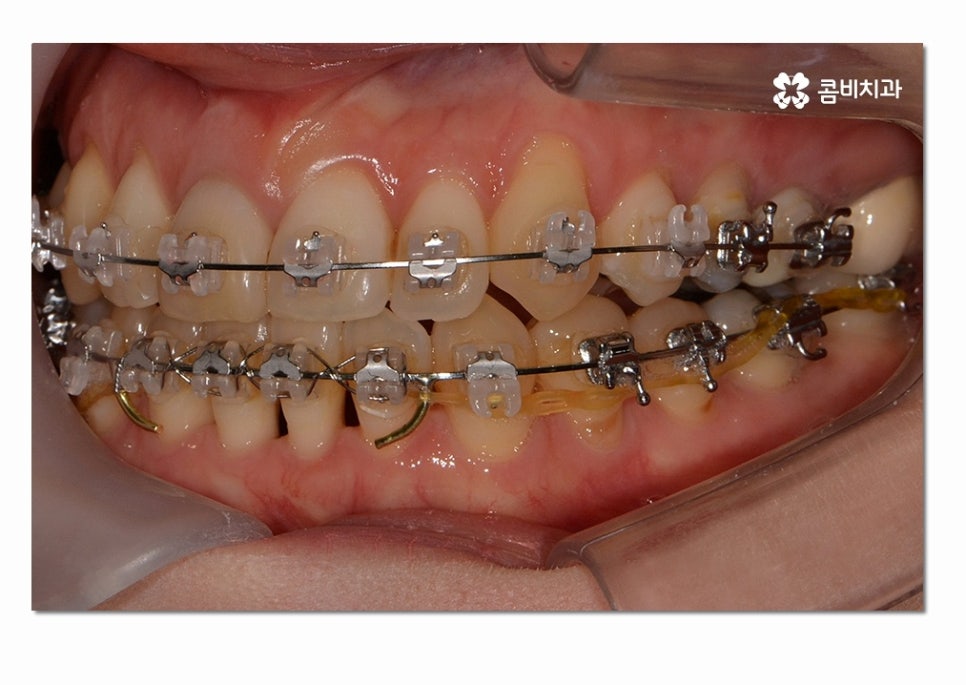 3급 부정교합 지금이라도 고치고 싶다면 관련 이미지 11