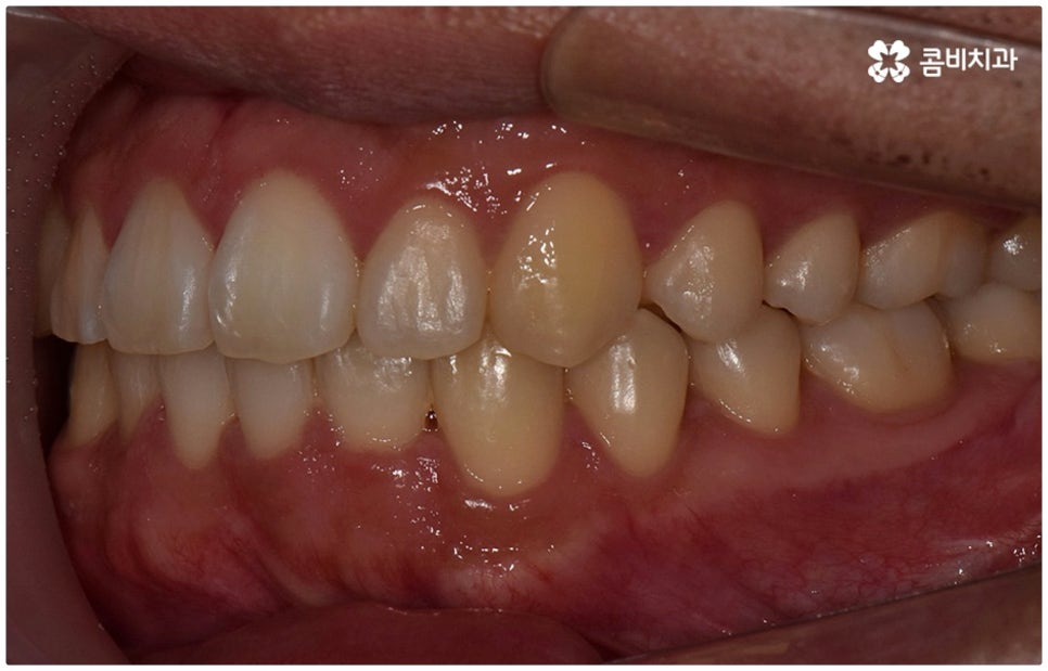 부정교합 3급 왜 고쳐야 하나요 관련 이미지 15