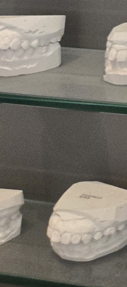 앞이빨 임플란트 과정 주의해야할 포인트는 관련 이미지 28