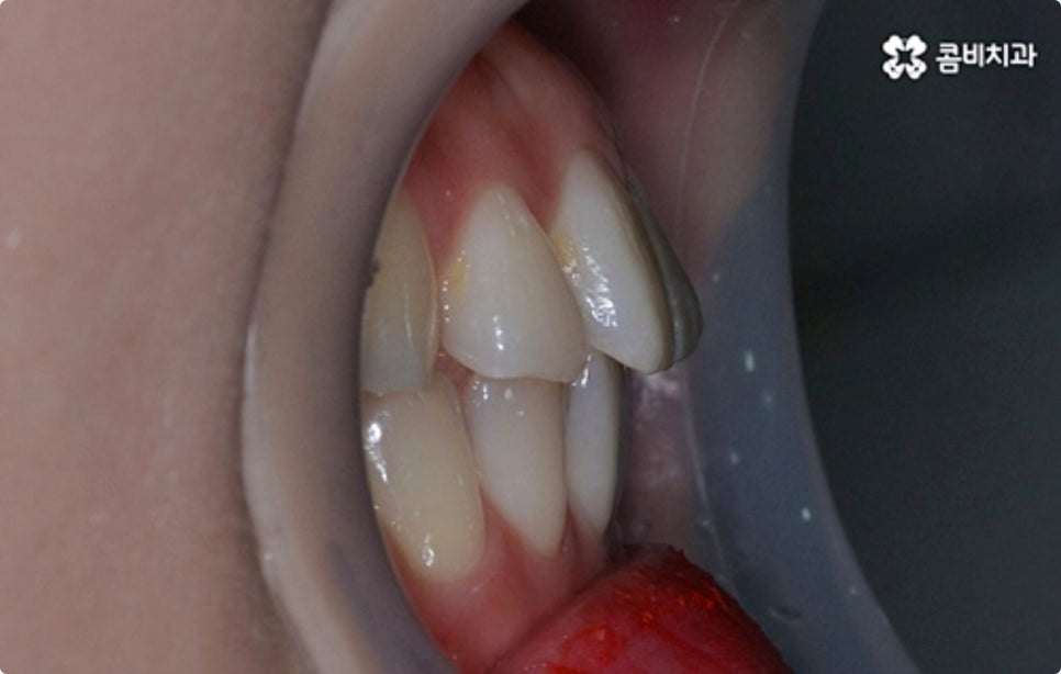 직장인치아교정 어떻게 시작하나요? 관련 이미지 5