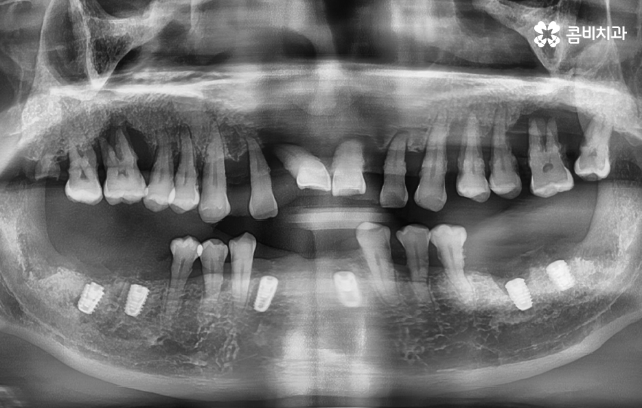 건강보험 임플란트 적용 받기 전에 알아두세요 관련 이미지 4
