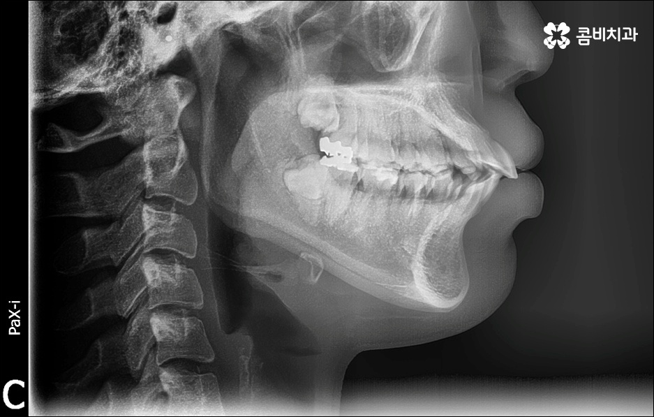 앞니 돌출 어떻게 고치나요? 관련 이미지 2