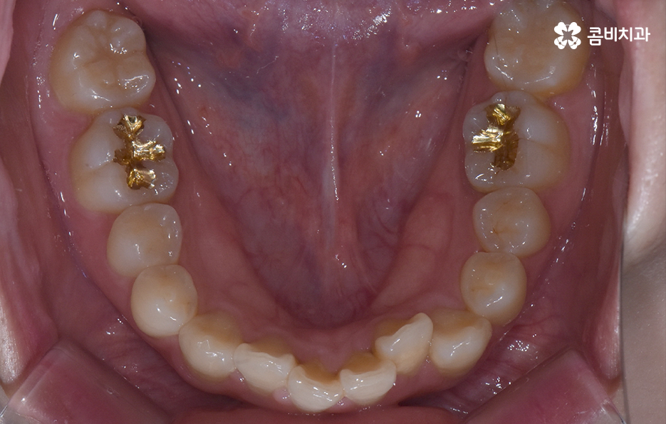 덧니 비발치 교정 자연스럽게 가능한 경우도 있어요 관련 이미지 6