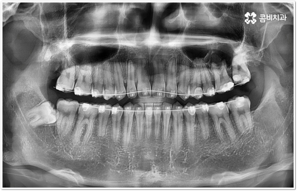 아래사랑니발치 망설이고 있다면 관련 이미지 8