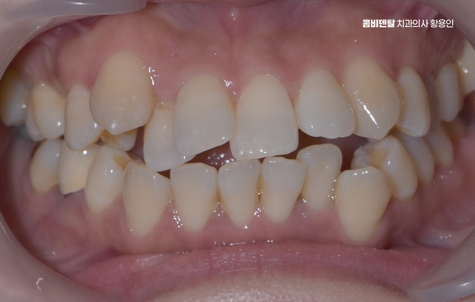 앞니 틀어짐 교정 조화롭게 마무리하려면 관련 이미지 1