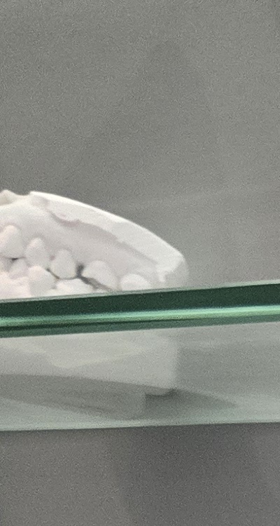 윗니 전체 임플란트 뭐부터 해야할까 관련 이미지 12