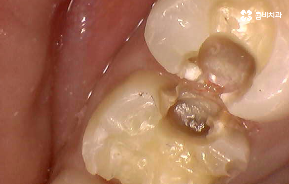 치아 사이 충치 까다로운 이유부터 알아보시죠 관련 이미지 2