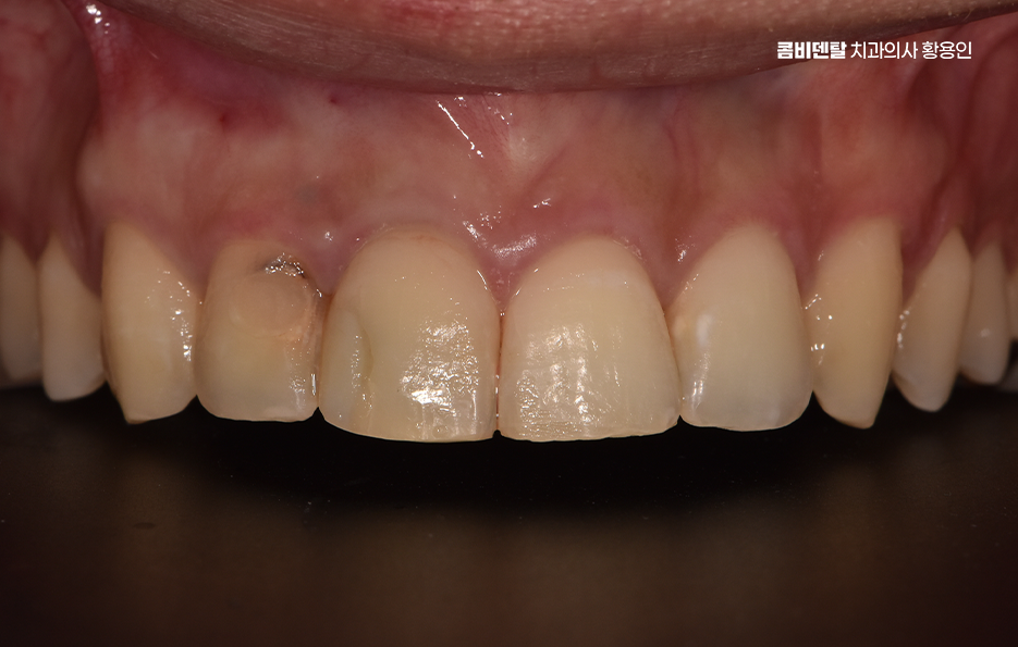 깨진 앞니 크라운 어떻게 해야 깔끔하게 해결될까 관련 이미지 1