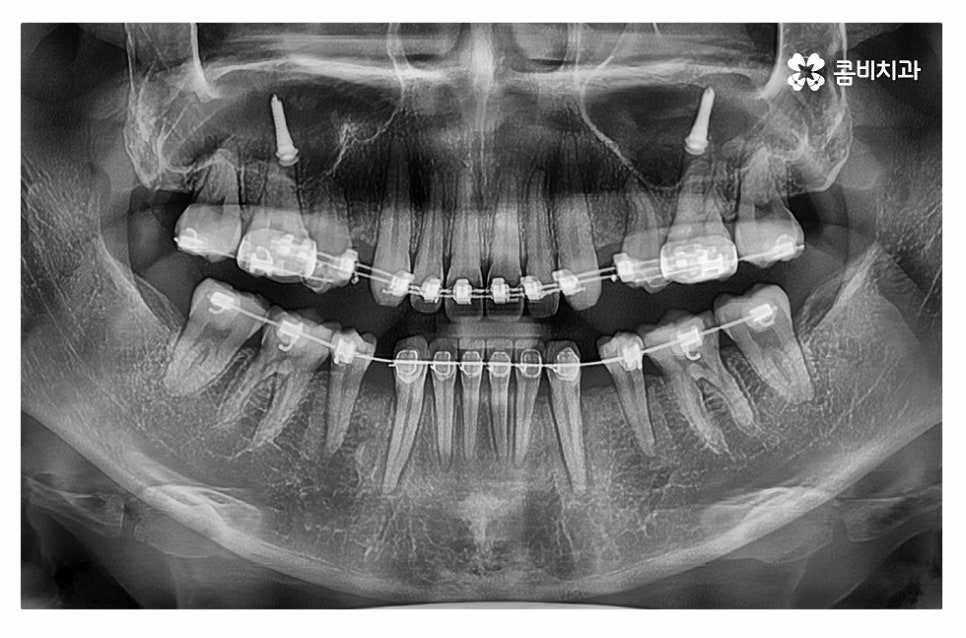 돌출입치아교정 적극적으로 해결하려면 관련 이미지 13