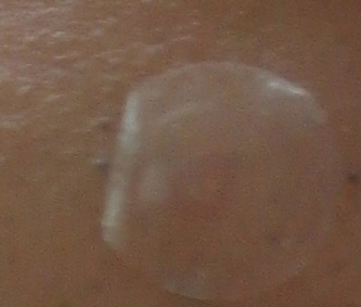 여드름패치 원더패치로 이젠 짜지 않아도 오케이 관련 이미지 9