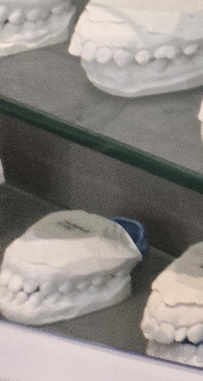 윗니 전체 임플란트 뭐부터 해야할까 관련 이미지 40