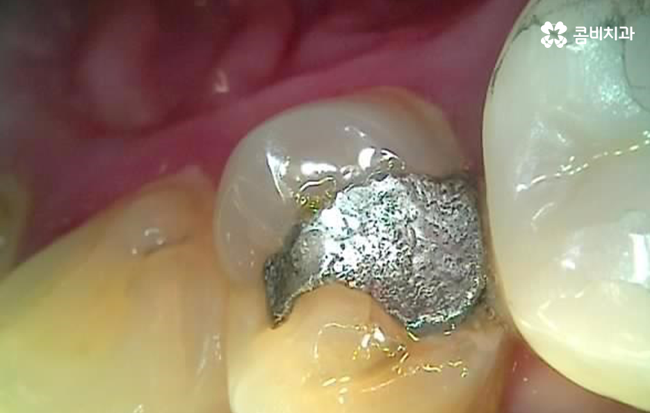 충치 단계 어떻게 분류하고 치료해야 하나요 관련 이미지 8