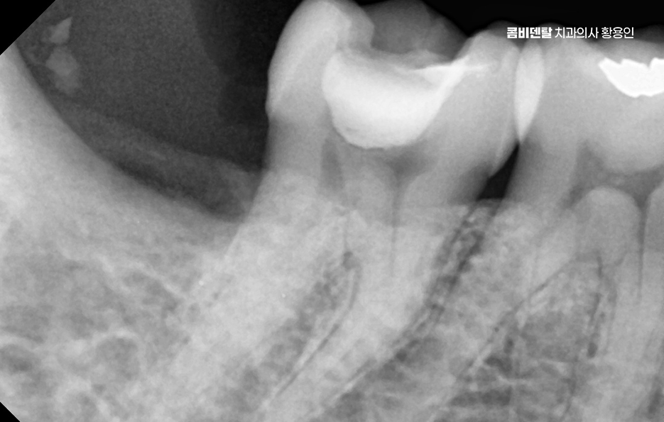 오래된 보철물 아말감 교체 어떠한 케이스일까 관련 이미지 9