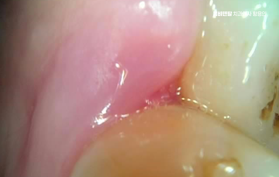 사랑니 주변 잇몸 통증 지금부터가 중요하니까 관련 이미지 5