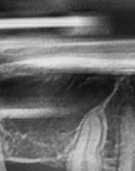 어금니 뒤 잇몸 부음 어떤 문제길래 이런거죠 관련 이미지 21