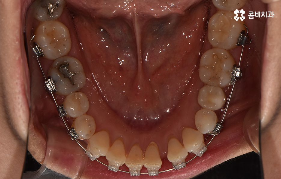 중년치아교정 이제라도 해도 될까요 관련 이미지 10