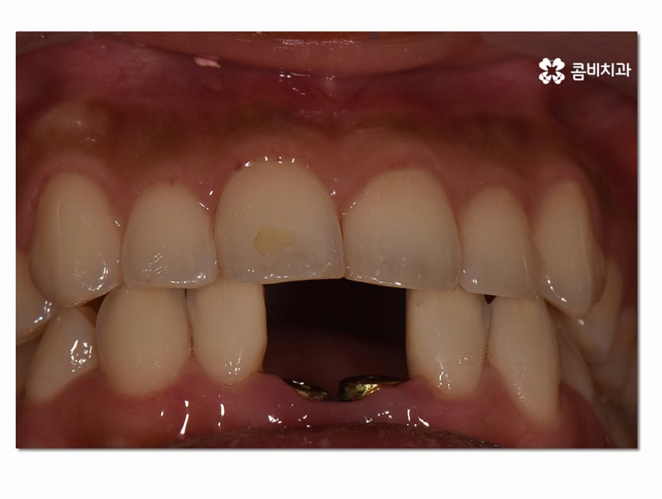 치주염으로 인한 아랫니 임플란트 절차를 알아보면 관련 이미지 7