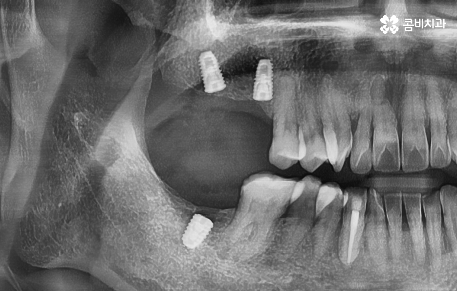 어금니 임플란트 기간 얼마나 예상해야 하나요 관련 이미지 3