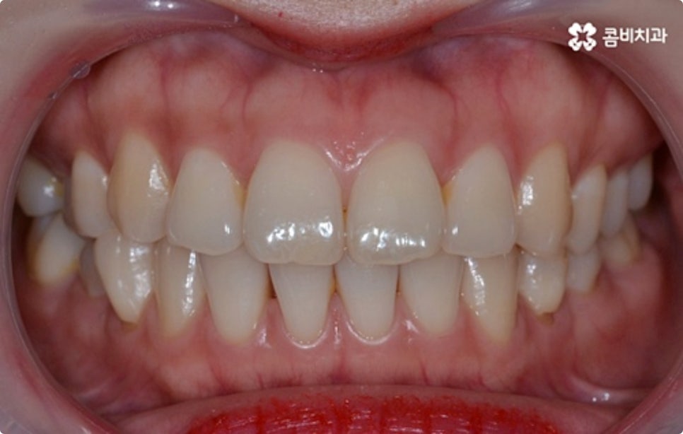 직장인치아교정 어떻게 시작하나요? 관련 이미지 3