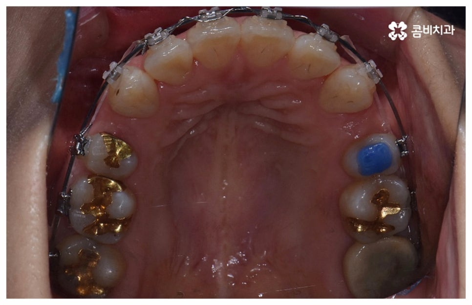 중년치아교정 원한다면 관련 이미지 13