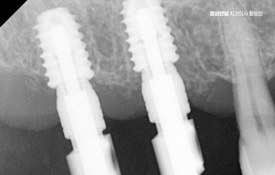 임플란트 뼈이식 안하면 어떤 문제가 있는거죠 관련 이미지 6