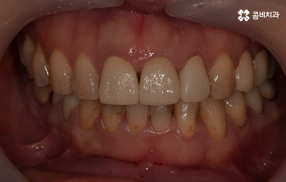 아래 앞니깨짐 치료 감쪽같이 해결하려면 관련 이미지 1