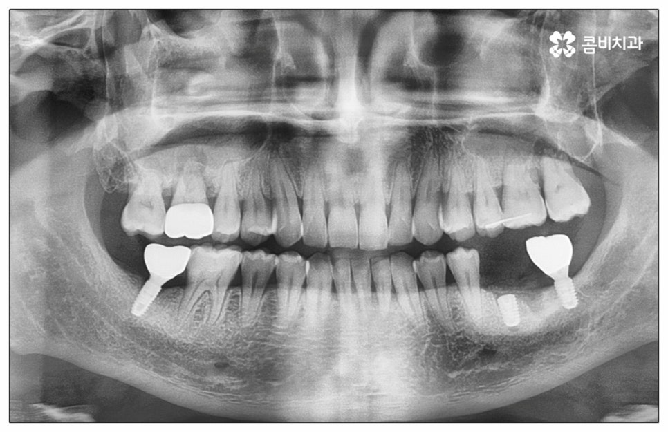 건강보험임플란트 혜택받아 보세요 관련 이미지 5
