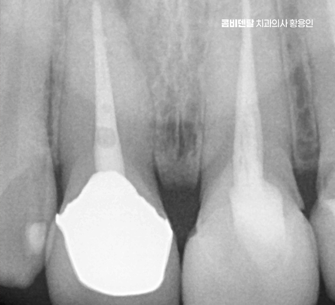 앞니 신경치료 크라운 까지 해야할 상황이라면 관련 이미지 4