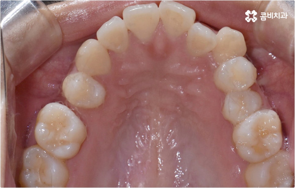 치아설측교정 보이지않아 좋아요 관련 이미지 8