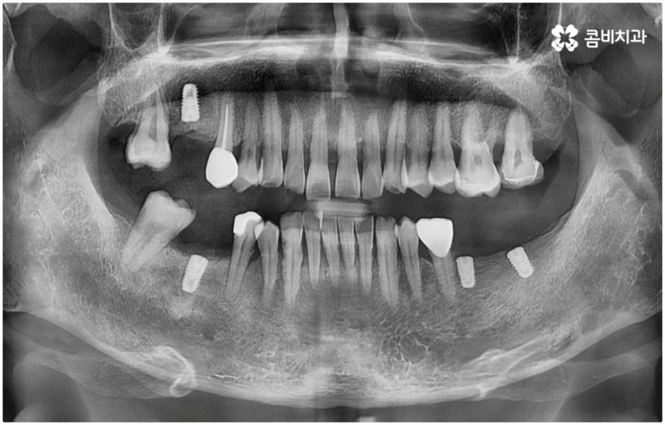 발치후 임플란트 바로 되나요? 관련 이미지 2