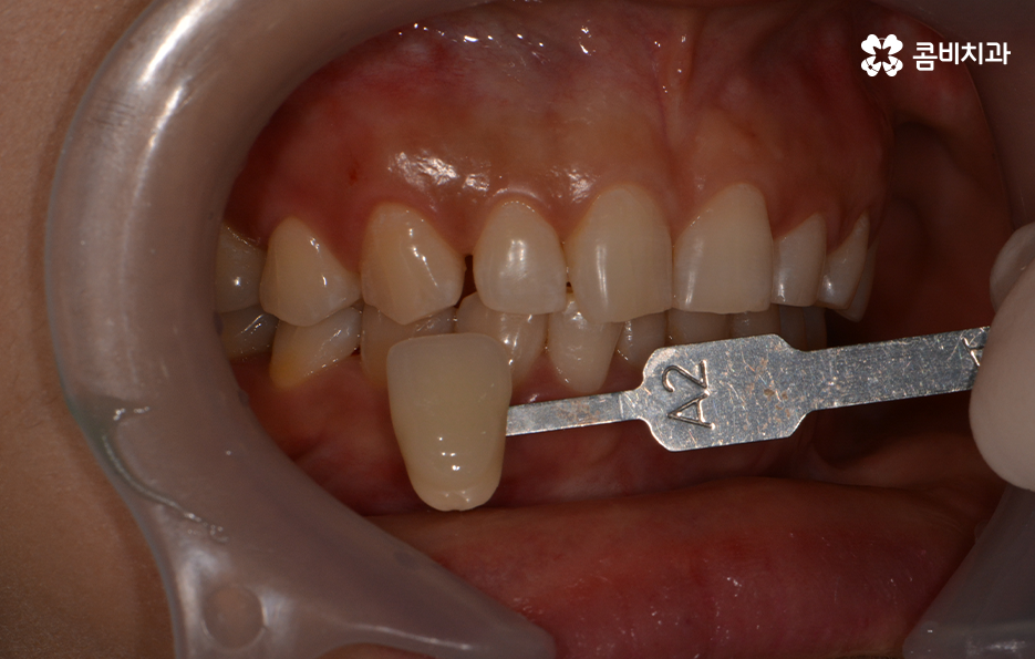 치과치아미백 어떻게 다른지 설명해드려요 관련 이미지 8