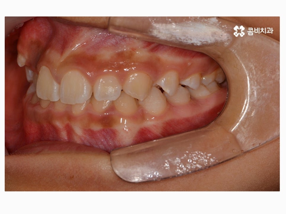 과개교합교정 어릴때 고쳐주면 좋은 사례 관련 이미지 4