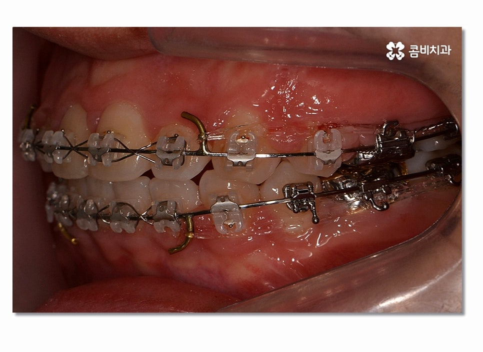 돌출입치아교정 부담이 크게 느껴진다면 관련 이미지 9