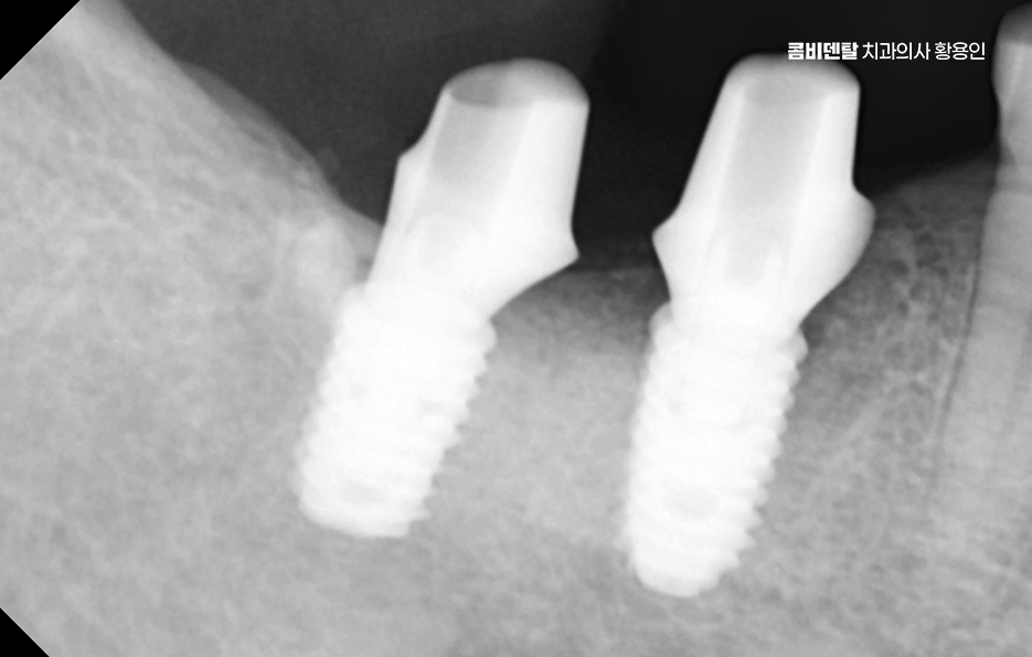 어금니 임플란트 과정 제대로 이해하려면 관련 이미지 9