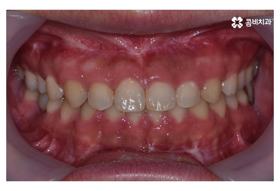 클리피씨교정 늦지않게 결정하려면 관련 이미지 14